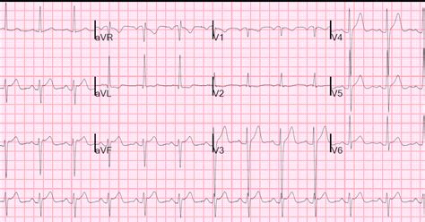 lvh with repolarization abnormality